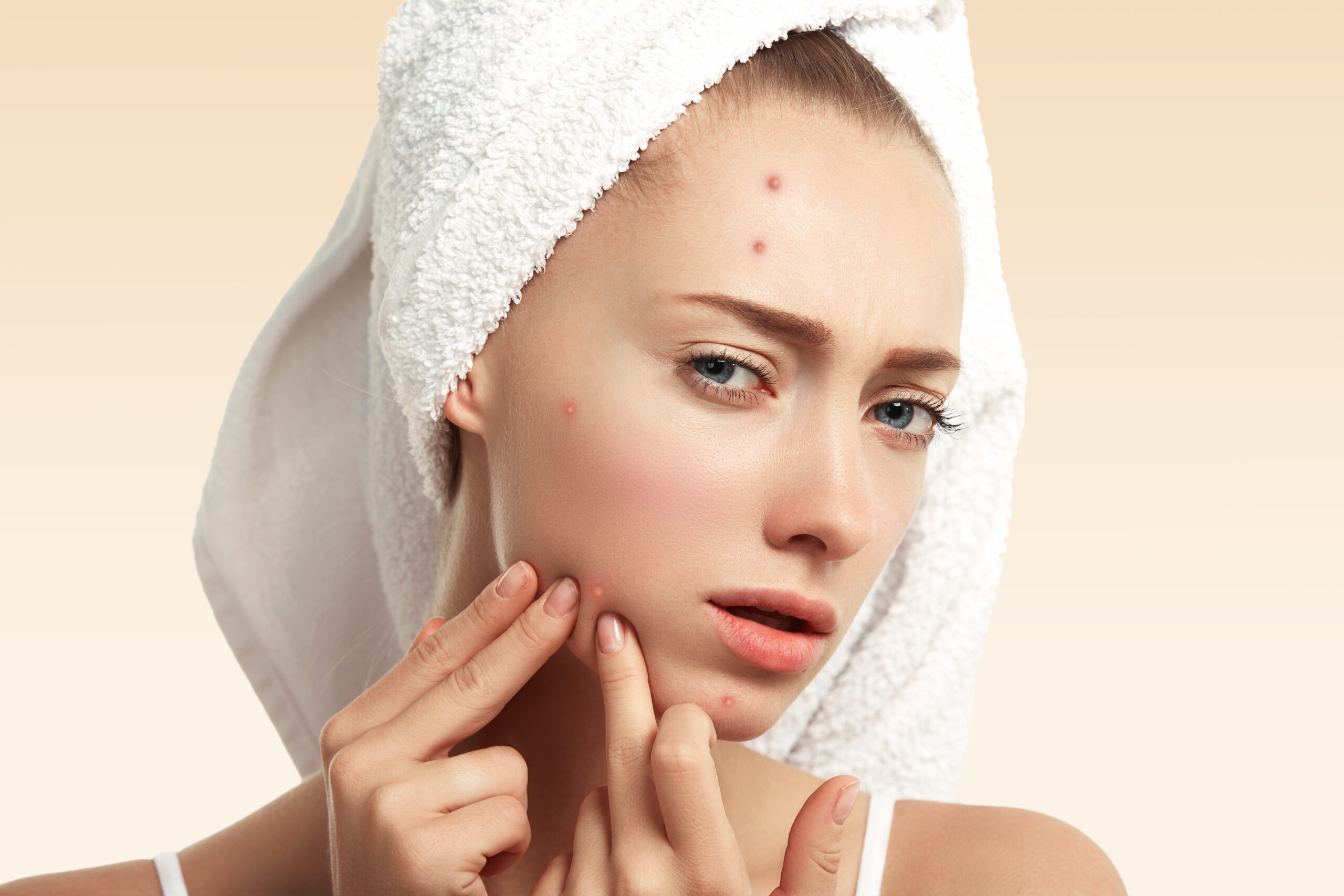 Save your face from Pimples || पिम्पल्स को हटाने के लिए यहां 10 बिंदुओं में विस्तृत जानकारी दी गई है: